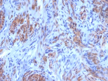 SMMHC Antibody SM-M10 Uterine Smooth Muscle IHC. Immunohistochemical staining of FFPE human uterus tissue demonstrates Smooth Muscle Myosin Heavy Chain expression using SMMHC antibody clone SM-M10. SMMHC, encoded by the MYH11 gene, is a highly specific marker of differentiated smooth muscle cells and a major component of the contractile apparatus. Prominent cytoplasmic staining is observed throughout intersecting fascicles of uterine smooth muscle cells, consistent with the abundant expression of MYH11 within the myometrium. The characteristic staining pattern highlights the organized architecture of contractile smooth muscle bundles responsible for uterine function. Heat induced epitope retrieval was performed by boiling tissue sections in pH 9 10 mM Tris with 1 mM EDTA for 20 minutes followed by cooling prior to staining. These results support the utility of SMMHC Antibody for studies of smooth muscle differentiation, reproductive biology, and soft tissue pathology.
