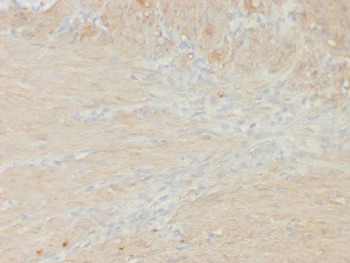 MYH11 Antibody Colon Smooth Muscle IHC. Immunohistochemical staining of FFPE human colon smooth muscle tissue demonstrates MYH11 expression using recombinant MYH11 antibody clone rMYH11/8066. MYH11, also known as Smooth Muscle Myosin Heavy Chain, is a principal component of the contractile apparatus and a highly specific marker of differentiated smooth muscle cells. Diffuse cytoplasmic staining is observed throughout bundles of smooth muscle fibers within the muscularis propria, consistent with the abundant expression of MYH11 in visceral smooth muscle responsible for intestinal motility. Heat induced epitope retrieval was performed by boiling tissue sections in pH 9 10 mM Tris with 1 mM EDTA for 20 minutes followed by cooling prior to staining. These results support the utility of MYH11 Antibody for studies of smooth muscle differentiation, gastrointestinal physiology, and contractile function.