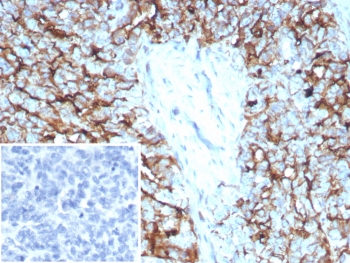 Mesothelin Antibody Ovarian Cancer IHC. Immunohistochemistry analysis of mesothelin expression in FFPE human ovarian carcinoma using clone MSLN/8391R. Strong membranous HRP-DAB brown staining is observed in malignant epithelial cells with additional cytoplasmic signal, consistent with mesothelin synthesis and cell surface localization. Tumor cell clusters are clearly delineated, while surrounding stromal elements show minimal reactivity, supporting specificity for mesothelin-expressing tumor cells.<BR>Negative control inset using PBS in place of the primary antibody shows no specific staining. Heat-induced epitope retrieval was performed in pH 9 Tris-EDTA buffer prior to immunostaining.