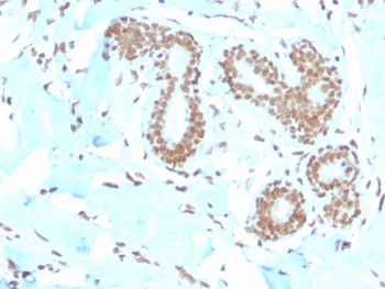 E2F4 Antibody Breast Carcinoma IHC. Immunohistochemistry analysis of FFPE human breast carcinoma tissue stained with E2F4 antibody detecting E2F transcription factor 4, clone E2F4/4224. Tumor epithelial cells show strong nuclear staining, consistent with localization of E2F4 as a transcriptional regulator within the RB pathway controlling cell cycle progression and gene repression. The staining highlights malignant glandular structures, while surrounding stromal regions show comparatively reduced signal. Hematoxylin counterstain highlights nuclei in blue. HIER: boil tissue sections in pH 9 10 mM Tris with 1 mM EDTA for 20 min and allow to cool before testing.