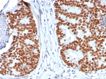TP53 Antibody / Cell Cycle Checkpoint Protein Antibody immunohistochemistry of human colon carcinoma. Formalin-fixed, paraffin-embedded human colon carcinoma tissue was stained using recombinant mouse monoclonal antibody clone rTP53/8063. Strong HRP-DAB brown nuclear staining is observed in tumor epithelial cells, consistent with nuclear localization of the TP53 cell cycle checkpoint protein p53. Hematoxylin counterstain provides nuclear contrast. Antigen retrieval was performed by boiling tissue sections in pH 9 10mM Tris with 1mM EDTA for 20 min followed by cooling prior to staining.