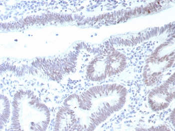 Immunohistochemistry analysis of TP53 / Tumor Protein 53 antibody in human colon carcinoma tissue (clone rTP53/8993). FFPE colon carcinoma sections demonstrate strong HRP-DAB brown nuclear staining in malignant epithelial cells lining glandular structures, consistent with nuclear accumulation of p53 protein in neoplastic cells. The staining pattern is predominantly nuclear with minimal cytoplasmic background and limited stromal signal. Adjacent non-neoplastic elements show weaker or absent staining by comparison. This nuclear localization aligns with the role of Tumor protein 53 as a transcription factor regulating cell cycle control and DNA damage responses. Heat induced epitope retrieval was performed by boiling tissue sections in pH 9 10mM Tris with 1mM EDTA for 20 minutes followed by cooling prior to primary antibody incubation.