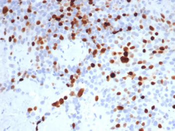 Topoisomerase II alpha Antibody Lymph Node IHC. Immunohistochemical analysis of DNA Topoisomerase II alpha (TOP2A) in formalin-fixed, paraffin-embedded human lymph node tissue using Topoisomerase II alpha antibody clone TOP2A/8103R. Strong nuclear HRP-DAB brown staining is observed in proliferating lymphocytes, with enrichment in germinal center regions, consistent with elevated expression during active cell division. HIER: boil tissue sections in pH 9 Tris-EDTA buffer for 20 min followed by cooling prior to staining.