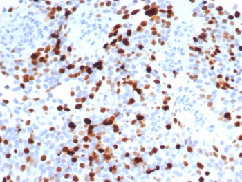 Topo IIa Antibody / Topoisomerase II alpha (clone TOP2A/7148R). Immunohistochemistry analysis of FFPE human lymph node tissue demonstrates strong nuclear staining of DNA Topoisomerase II alpha in proliferating lymphoid cells. Nuclear immunoreactivity is enriched within germinal center lymphocytes, reflecting elevated expression of Topo IIa in rapidly dividing immune cells. As a Topo IIa antibody, clone TOP2A/7148R highlights cells in which DNA Topoisomerase II alpha regulates DNA topology and chromosome organization during cell division. HIER: boil tissue sections in pH 9 Tris-EDTA buffer for 20 min followed by cooling at RT prior to immunohistochemistry staining.