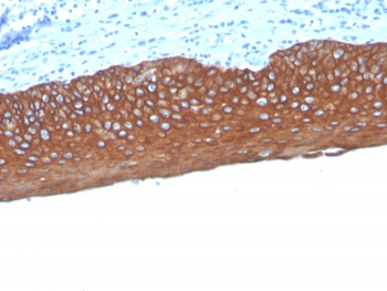 Pan Cytokeratin Antibody human tonsil IHC. Immunohistochemistry analysis of cytokeratin expression in FFPE human tonsil tissue using Pan Cytokeratin antibody clone MonoPoly/4999R. Strong cytoplasmic HRP-DAB brown staining highlights epithelial cells within the tonsillar surface epithelium, clearly delineating epithelial structures against lymphoid tissue. The staining pattern supports epithelial lineage identification and demonstrates reliable detection of epithelial cells within complex tissue environments. HIER was performed by boiling tissue sections in pH 9 10 mM Tris with 1 mM EDTA for 20 minutes followed by cooling prior to antibody incubation.