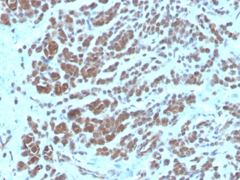 IHC staining of FFPE human breast carcinoma tissue with NME2 antibody (clone NME2/6435). HIER: boil tissue sections in pH 9 10mM Tris with 1mM EDTA for 20 min and allow to cool before testing.