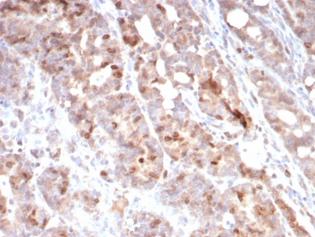 IHC staining of FFPE human colon carcinoma tissue with Survivin antibody (clone BIRC5/7775). HIER: boil tissue sections in pH 9 10mM Tris with 1mM EDTA for 20 min and allow to cool before testing.