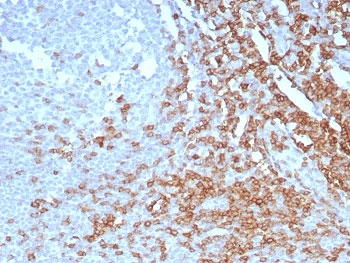 CD7 Antibody Tonsil IHC. Immunohistochemistry analysis of CD7 / T-cell antigen CD7 in human tonsil tissue demonstrates strong HRP-DAB brown membranous staining of lymphocytes within interfollicular regions with relative sparing of germinal centers, consistent with CD7 expression on cytotoxic lymphocyte populations including effector T cells, while surrounding areas remain largely negative. CD7 antibody clone CD7/7605 was applied following heat-induced epitope retrieval in pH 9 Tris-EDTA buffer, supporting its use as a cytotoxic lymphocyte marker in FFPE tissue sections.
