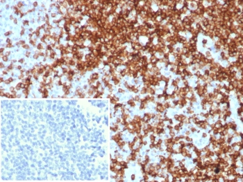CD7 Antibody Human Tonsil IHC. Immunohistochemistry analysis of CD7 / T-cell antigen CD7 in human tonsil tissue shows strong HRP-DAB brown membranous staining of lymphoid cells within interfollicular regions, consistent with CD7 expression across T cell lineage populations, while surrounding areas remain largely negative. The inset shows absence of staining when PBS is used in place of primary antibody, confirming specificity. CD7 antibody clone CD7/8496R was applied following heat-induced epitope retrieval in pH 9 Tris-EDTA buffer, supporting its use as a T cell lineage marker in FFPE tissue sections.
