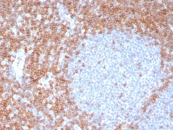 CD7 Antibody Tonsil IHC. Immunohistochemistry analysis of CD7 / T-cell antigen CD7 in human tonsil tissue demonstrates strong HRP-DAB brown membranous staining of lymphoid cells concentrated in interfollicular regions with relative sparing of germinal centers, consistent with CD7-positive T lymphocyte populations relevant to leukemia and lymphoma biology, while surrounding non-lymphoid areas remain largely negative. CD7 antibody clone CD7/8118R was applied following heat-induced epitope retrieval in pH 9 Tris-EDTA buffer, supporting its use as a leukemia and lymphoma marker in FFPE tissue sections.
