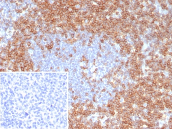 CD7 Antibody Human Tonsil IHC. Immunohistochemistry analysis of CD7 / T-cell antigen CD7 in human tonsil tissue shows strong HRP-DAB brown membranous staining of lymphoid cells within interfollicular regions with relative sparing of germinal centers, consistent with CD7-positive T lymphocyte populations relevant to leukemia and lymphoma studies, while surrounding areas remain largely negative. The inset shows absence of staining when PBS is used in place of primary antibody, confirming specificity. CD7 antibody clone CD7/8118R was applied following heat-induced epitope retrieval in pH 9 Tris-EDTA buffer, supporting its use as a leukemia and lymphoma marker in FFPE tissue sections.