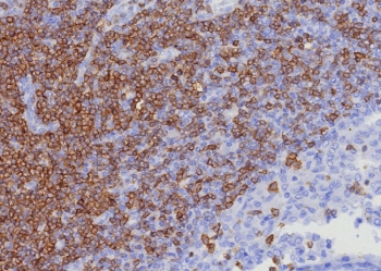 CD7 Antibody Lymph Node IHC. Immunohistochemistry analysis of CD7 / T-cell antigen CD7 in human lymph node tissue demonstrates strong HRP-DAB brown membranous staining of densely packed small lymphocytes within paracortical regions, consistent with surface expression of CD7 on T cell populations, while surrounding stromal areas remain largely negative. CD7 antibody clone CD7/8357R was applied following heat-induced epitope retrieval in pH 9 Tris-EDTA buffer, supporting its use as an immune cell surface marker in FFPE tissue sections.