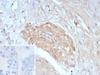 IHC staining of FFPE human testis tissue with recombinant Survivin antibody (clone BIRC5/8936R). Inset: PBS used in place of primary Ab (secondary Ab negative control). HIER: boil tissue sections in pH 9 10mM Tris with 1mM EDTA for 20 min and allow to cool before testing.