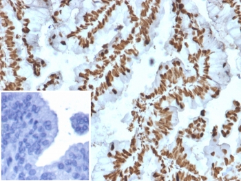 ZNF846 Zinc Finger Transcription Regulator Antibody Prostate Carcinoma IHC. Immunohistochemistry analysis of FFPE human prostate carcinoma tissue using ZNF846 Antibody (clone PCRP-ZNF846-1E12) shows strong nuclear staining in tumor epithelial cells, consistent with ZNF846 localization as a zinc finger transcription-associated protein. The staining highlights glandular tumor architecture, while surrounding stromal regions display comparatively lower signal. Inset: PBS used in place of primary antibody confirms minimal non-specific background staining. Hematoxylin counterstain provides nuclear contrast and structural context. HIER: boil FFPE tissue sections in pH 9 10 mM Tris with 1 mM EDTA for 20 min and allow to cool before testing.