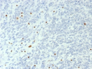 SMARCA4 Antibody Recombinant Rabbit MAb BRG1/6531R. Immunohistochemistry analysis of BRG1 / SMARCA4 in FFPE human ovarian small cell carcinoma tissue demonstrates largely negative tumor cell nuclei with only scattered HRP-DAB brown nuclear staining in a small subset of cells. This staining pattern is consistent with the known loss or reduced expression of BRG1 in many SMARCA4-deficient ovarian small cell carcinomas. Occasional positive nuclei may represent residual BRG1-expressing cells or non-tumor stromal elements within the tumor microenvironment. Heat induced epitope retrieval was performed by boiling tissue sections in pH 9 10mM Tris buffer with 1mM EDTA for 20 minutes followed by cooling prior to antibody incubation.