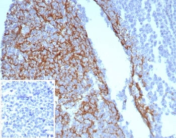 Immunohistochemistry of CD23 Antibody in human tonsil. FFPE human tonsil tissue was stained with CD23 antibody (clone FCER2/8234R). Strong membranous HRP-DAB brown staining is observed in B lymphocytes within germinal centers and mantle zone regions, consistent with known CD23 expression on mature follicular B cells. The staining pattern highlights follicular architecture, with dense positive labeling in B cell rich areas and minimal staining in surrounding T cell predominant interfollicular zones. The inset image shows the PBS negative control processed without primary antibody, demonstrating absence of specific staining. Heat induced epitope retrieval was performed by boiling tissue sections in pH 9 Tris-EDTA buffer for 20 minutes followed by cooling prior to antibody incubation.