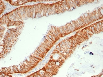 IHC staining of FFPE human colon carcinoma tissue with HAb18G/CD147 antibody (clone BSG/7957). HIER: boil tissue sections in pH 9 10mM Tris with 1mM EDTA for 20 min and allow to cool before testing.