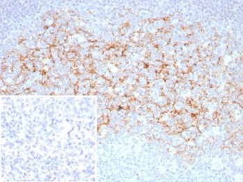 Immunohistochemistry of CD23 Antibody in human tonsil. FFPE human tonsil tissue was stained with CD23 antibody rabbit monoclonal FCER2/8510R. Prominent membranous HRP-DAB brown staining is observed in B lymphocytes within germinal centers and mantle zone regions, consistent with established CD23 expression on mature follicular B cells. The staining pattern clearly outlines follicular architecture, with dense positivity in B cell rich areas and minimal staining in adjacent interfollicular T cell zones. The inset image shows the PBS negative control processed without primary antibody, demonstrating absence of specific staining. Heat induced epitope retrieval was performed by boiling tissue sections in pH 9 Tris-EDTA buffer for 20 minutes followed by cooling prior to antibody incubation.