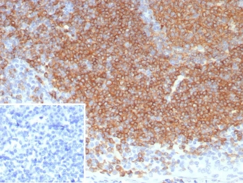 CD22 Antibody Tonsil IHC. Immunohistochemistry analysis of CD22/Siglec-2 expression in FFPE human tonsil tissue using CD22 Antibody / B Cell Lineage Marker Antibody clone BLCAM/8113R. Strong HRP-DAB brown membranous and cytoplasmic staining is observed in dense B lymphocyte populations within germinal centers and mantle zones, clearly delineating B cell-rich compartments, while surrounding non-lymphoid cells remain largely unstained. The staining pattern is consistent with CD22 as a B cell lineage marker and supports its use for immunohistochemistry-based identification of B lymphocytes within lymphoid tissues. Inset: PBS was used in place of the primary antibody as a negative control to assess non-specific secondary antibody binding.