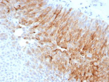 Immunohistochemistry of Uroplakin 1A antibody in human bladder carcinoma. Formalin-fixed, paraffin-embedded human bladder carcinoma tissue was stained with recombinant rabbit monoclonal Uroplakin 1A antibody (clone UPK1A/8704R) following heat-induced epitope retrieval by boiling in pH 9 10 mM Tris with 1 mM EDTA for 20 minutes and cooling prior to testing. HRP-DAB brown chromogenic signal highlights strong membranous staining in tumor cells, consistent with the apical membrane localization of Uroplakin 1A in urothelial differentiation, while surrounding stromal and non-urothelial cells remain largely negative.