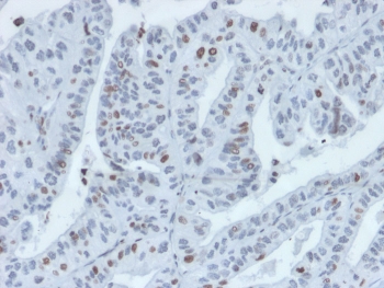 Interferon Regulatory Factor 3 Antibody Tumor IHC. Immunohistochemistry analysis of FFPE human tumor tissue stained with Interferon Regulatory Factor 3 Antibody demonstrates predominantly nuclear HRP-DAB brown staining within malignant epithelial cell populations, consistent with activated IRF3-associated antiviral signaling and interferon-regulatory transcriptional pathway activity. This antiviral response protein antibody highlights innate immune-associated transcriptional regulation and stress-response signaling within tumor tissue. HIER: boil tissue sections in pH 9 10mM Tris with 1mM EDTA for 20 min and allow to cool before testing.