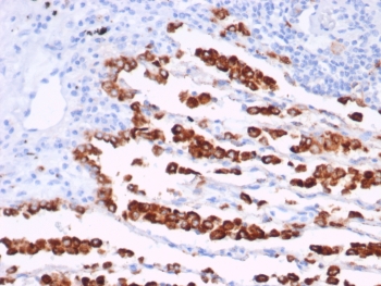 IHC staining of FFPE human lung adenocarcinoma tissue with recombinant NAPSA antibody antibody (clone rNAPSA/7239) at 2ug/ml. HIER: boil tissue sections in pH 9 10mM Tris with 1mM EDTA for 20 min and allow to cool before testing.