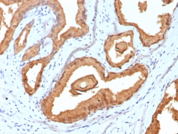 Prostate Specific Antigen Antibody Recombinant MAb clone rKLK3/6947 immunohistochemistry analysis of human prostate carcinoma tissue. Formalin-fixed paraffin-embedded human prostate carcinoma tissue stained with Prostate Specific Antigen Antibody Recombinant MAb (clone rKLK3/6947) shows HRP-DAB brown chromogenic staining in tumor epithelial cells forming glandular structures. Strong cytoplasmic staining highlights malignant prostate epithelial cells, with luminal accentuation reflecting the secretory localization of Prostate specific antigen (KLK3). Surrounding stromal cells are largely negative. Heat induced epitope retrieval was performed by boiling tissue sections in pH 9 10mM Tris with 1mM EDTA for 20 minutes followed by cooling prior to antibody incubation.