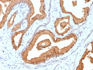 Prostate Specific Antigen Antibody rKLK3/6947 immunohistochemistry analysis of human prostate carcinoma tissue. Formalin-fixed paraffin-embedded human prostate carcinoma tissue stained with Prostate Specific Antigen Antibody Recombinant MAb (clone rKLK3/6947) shows HRP-DAB brown chromogenic staining in tumor epithelial cells forming glandular structures. Strong cytoplasmic staining highlights malignant prostate epithelial cells, with luminal accentuation reflecting the secretory localization of Prostate specific antigen (KLK3). Surrounding stromal cells are largely negative. Heat induced epitope retrieval was performed by boiling tissue sections in pH 9 10mM Tris with 1mM EDTA for 20 minutes followed by cooling prior to antibody incubation.