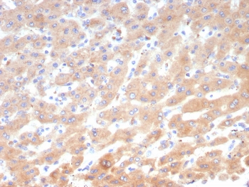 IHC staining of FFPE human hepatocellular carcinoma tissue with Ob-R antibody (clone LEPR/4545). HIER: boil tissue sections in pH 9 10mM Tris with 1mM EDTA for 20 min and allow to cool before testing.