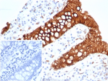 S100A16 Antibody Tumor Epithelium IHC. Immunohistochemistry of S100 calcium binding protein A16 / S100A16 in FFPE human colon carcinoma tissue using mouse monoclonal S100A16 antibody, clone S100A16/7412. HRP-DAB brown staining highlights strong cytoplasmic and membranous labeling of malignant epithelial cells forming glandular structures, with heterogeneous intensity consistent with tumor-associated proliferation and altered differentiation, while surrounding stromal elements show minimal staining and nuclei are counterstained blue. Inset: PBS was used in place of primary antibody as a negative control to confirm specificity of staining. Heat induced epitope retrieval was performed by boiling tissue sections in pH 9 10 mM Tris with 1 mM EDTA for 20 min followed by cooling prior to staining.