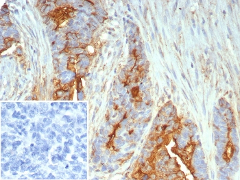 Immunohistochemistry analysis of Mucin 1 / MUC1 antibody (clone MUC1/7797R) in human ovarian cancer tissue. FFPE human ovarian carcinoma section shows strong membranous and cytoplasmic brown chromogenic staining in tumor epithelial cells, consistent with MUC1 expression, while adjacent stromal cells show minimal staining and nuclei appear blue. The inset shows PBS used in place of primary antibody as a negative control with no specific staining observed. Heat-induced epitope retrieval was performed by boiling tissue sections in pH 9 10 mM Tris with 1 mM EDTA for 20 minutes followed by cooling prior to staining.
