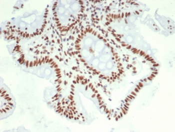 IHC staining of FFPE human colon carcinoma tissue with Hepatoma Derived Growth Factor antibody (clone PCRP-HDGF-1D1). HIER: boil tissue sections in pH 9 10mM Tris with 1mM EDTA for 20 min and allow to cool before testing.