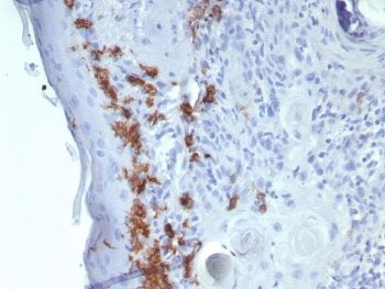 CD1A Antibody for IHC. Immunohistochemistry analysis of CD1A / CD1a expression in FFPE human skin tissue using CD1A Antibody. Membranous and cytoplasmic staining is observed in dendritic cells within the epidermis, consistent with Langerhans cell localization, while surrounding keratinocytes remain largely negative. The presence of CD1a-positive cells within the epithelial layer reflects expression in immature antigen-presenting cells and supports identification of early-stage immune cell populations associated with thymocyte-related differentiation pathways. HIER: boil tissue sections in pH 9 10 mM Tris with 1 mM EDTA for 20 minutes and allow to cool before testing.