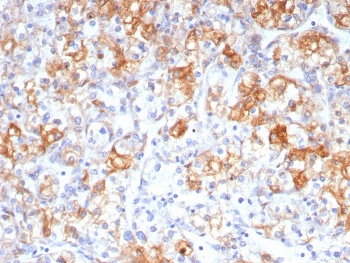 Immunohistochemistry analysis of COX2 / Cyclooxygenase 2 antibody (clone rCOX2/6996). FFPE human renal cell carcinoma tissue demonstrates cytoplasmic and membranous HRP-DAB brown staining in tumor epithelial cells, consistent with elevated COX2 expression in malignant renal epithelium. Surrounding stromal elements show minimal to weak staining. Antigen retrieval was performed by boiling tissue sections in pH 9 10mM Tris with 1mM EDTA for 20 min followed by cooling prior to staining.