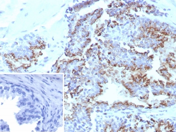 Prostein Antibody for IHC. Immunohistochemistry analysis of Prostein / SLC45A3 antibody staining in FFPE human prostate tissue using clone SLC45A3/7648. Strong cytoplasmic and perinuclear staining is observed in prostate glandular epithelial cells outlining luminal structures, consistent with Golgi-associated localization of Prostein, while surrounding stromal cells remain negative. The staining highlights prostate epithelial lineage and preserves glandular architecture, supporting the role of SLC45A3 as a prostate lineage biomarker. The inset shows a PBS negative control with no staining, confirming specificity of the signal. Heat-induced epitope retrieval was performed in pH 9 Tris-EDTA buffer for 20 minutes followed by cooling prior to antibody incubation.