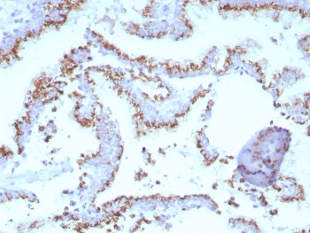 Prostein Antibody for IHC. Immunohistochemistry analysis of Prostein / SLC45A3 antibody staining in FFPE human prostate tissue using clone SLC45A3/7647. Prominent cytoplasmic and perinuclear staining is observed in prostate glandular epithelial cells forming luminal structures, with a punctate distribution consistent with Golgi-associated localization of Prostein, while surrounding stromal elements remain largely negative. The staining pattern highlights epithelial cell polarity and intracellular compartmentalization associated with solute carrier transport processes within the secretory pathway. Heat-induced epitope retrieval was performed in pH 9 Tris-EDTA buffer for 20 minutes followed by cooling prior to antibody incubation.