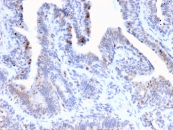 LRH1 Antibody Prostate Carcinoma IHC. Immunohistochemistry staining of FFPE human prostate carcinoma tissue using monoclonal clone PCRP-NR5A2-1B8 demonstrates predominantly nuclear HRP-DAB brown staining within malignant glandular epithelial cells, consistent with localization of Liver receptor homolog 1 / NR5A2 as a nuclear receptor transcription factor involved in metabolic and epithelial regulatory signaling pathways. The staining pattern highlights transcription factor-associated nuclear enrichment within prostate tumor epithelium. HIER: boil tissue sections in pH 9 10mM Tris with 1mM EDTA for 20 min and allow to cool before testing.