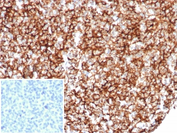 CR1 Antibody Tonsil IHC. Immunohistochemistry of Complement Receptor 1 / CR1 in FFPE human tonsil tissue using recombinant mouse monoclonal CR1 antibody, clone rCR1/8599. HRP-DAB brown staining highlights a dense reticular follicular dendritic cell network within germinal centers, showing a characteristic mesh-like pattern consistent with complement receptor localization and germinal center architecture, while surrounding lymphocytes show minimal staining and nuclei are counterstained blue. Inset: PBS was used in place of primary antibody as a negative control to confirm specificity of staining. Heat induced epitope retrieval was performed by boiling tissue sections in pH 9 10 mM Tris with 1 mM EDTA for 20 min followed by cooling prior to staining.