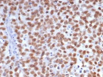 IHC staining of FFPE human seminoma tissue with Sal-like 4 antibody (clone SALL4/7802R). HIER: boil tissue sections in pH 9 10mM Tris with 1mM EDTA for 20 min and allow to cool before testing.