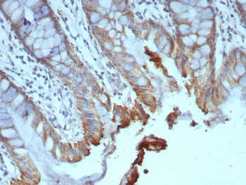 B7RP-1 Antibody Colon Carcinoma IHC. Immunohistochemistry analysis of FFPE human colon carcinoma tissue stained with clone ICOSL/7700. Tumor epithelial cells display membranous and cytoplasmic HRP-DAB brown staining consistent with expression of B7-related protein 1 / ICOSLG, an immune costimulatory ligand involved in adaptive immune signaling and regulation of T-cell activation within the tumor microenvironment. Adjacent stromal tissue demonstrates comparatively reduced staining intensity. HIER: boil tissue sections in pH 9 10mM Tris with 1mM EDTA for 20 min and allow to cool before testing.