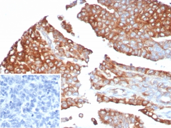 MX1 Antibody Ovarian Cancer IHC. Immunohistochemical staining of FFPE human ovarian cancer tissue using MX1 Antibody / Antiviral Response Protein Antibody (clone MX1/7527) demonstrates strong cytoplasmic and membranous HRP-DAB brown staining throughout malignant epithelial tumor cells. MX1 (Myxovirus Resistance Protein 1) is an interferon-inducible dynamin-like GTPase that functions as a key mediator of innate antiviral immunity and host defense. As a downstream effector of interferon signaling pathways, MX1 contributes to restriction of viral replication and serves as a widely utilized marker of interferon-responsive cellular activity. The observed staining pattern is consistent with expression of MX1 within neoplastic epithelial cells and supports the utility of this antibody for immunohistochemical detection of antiviral response proteins and interferon-regulated pathways in human tissues. Inset: PBS was used in place of the primary antibody as a negative control. HIER: boil tissue sections in pH 9, 10 mM Tris with 1 mM EDTA for 20 minutes and allow to cool before testing.