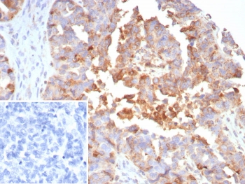 Myxovirus Resistance Protein 1 Antibody Ovarian Cancer IHC. Immunohistochemical staining of FFPE human ovarian cancer tissue using Myxovirus Resistance Protein 1 Antibody / MX1 Antibody (clone MX1/7530) demonstrates moderate to strong granular cytoplasmic HRP-DAB brown staining within malignant epithelial tumor cells. MX1 is an interferon-inducible dynamin-like GTPase that functions as a key mediator of innate antiviral immunity and interferon-regulated host defense pathways. As a downstream effector of interferon signaling, MX1 contributes to cellular antiviral responses and is widely utilized as a marker of interferon pathway activation. The observed staining pattern is consistent with expression of MX1 within neoplastic epithelial cells and supports the utility of this antibody for immunohistochemical detection of interferon-responsive proteins in human tissues. Inset: PBS was used in place of the primary antibody as a negative control. HIER: boil tissue sections in pH 9, 10 mM Tris with 1 mM EDTA for 20 minutes and allow to cool before testing.