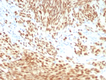 PRAME Antibody Melanoma IHC. Immunohistochemistry analysis of FFPE human melanoma tissue stained with recombinant rabbit monoclonal PRAME antibody clone PRAME/8558R. Tumor cells demonstrate strong nuclear HRP-DAB brown staining consistent with expression of Preferentially expressed antigen in melanoma / PRAME, a cancer-testis antigen involved in tumor-associated immune signaling and transcriptional regulation pathways. The observed staining pattern is consistent with established PRAME expression in melanoma-associated tumor cell populations. HIER: boil tissue sections in pH 9 10mM Tris with 1mM EDTA for 20 min and allow to cool before testing.