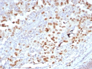 OIP-4 Antibody Melanoma IHC. Immunohistochemistry analysis of FFPE human melanoma tissue stained with recombinant rabbit monoclonal OIP-4 antibody clone PRAME/6928R. Tumor cells demonstrate prominent nuclear HRP-DAB brown staining consistent with expression of Opa-interacting protein 4 / PRAME, a cancer-testis antigen involved in tumor-associated immune signaling and transcriptional regulation pathways. The observed staining pattern is consistent with established PRAME expression in melanoma-associated tumor cell populations. HIER: boil tissue sections in pH 9 10mM Tris with 1mM EDTA for 20 min and allow to cool before testing.