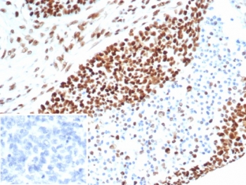 Immunohistochemistry analysis of MSH6 antibody in human ovarian carcinoma tissue. MSH6 Antibody Recombinant Rabbit MAb MSH6/7064R was used for immunohistochemistry on FFPE human ovarian carcinoma tissue. Distinct HRP-DAB brown nuclear staining is observed in tumor epithelial cells, consistent with the nuclear localization of MutS homolog 6 (MSH6), a DNA mismatch repair protein involved in recognition of replication errors during DNA synthesis. The tumor cell nuclei demonstrate strong positive staining, while surrounding stromal cells show minimal or absent signal. The inset panel shows the negative control in which PBS was used in place of the primary antibody, confirming the specificity of the staining. Heat-induced epitope retrieval was performed by boiling tissue sections in pH 9 10mM Tris with 1mM EDTA for 20 min followed by cooling prior to immunostaining.