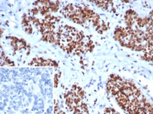 Immunohistochemistry analysis of MSH6 antibody in human ovarian cancer tissue. MSH6 Antibody Rabbit Monoclonal MSH6/8338R was used for immunohistochemistry on FFPE human ovarian carcinoma tissue. Strong HRP-DAB brown nuclear staining is observed in malignant epithelial cells, consistent with the nuclear localization of MutS homolog 6 (MSH6), a key DNA mismatch repair protein involved in recognition of replication errors. Tumor cell nuclei show prominent positive staining, while surrounding stromal elements display minimal signal. The inset panel shows the negative control in which PBS was used in place of the primary antibody, demonstrating absence of nuclear staining. Heat-induced epitope retrieval was performed by boiling tissue sections in pH 9 10mM Tris with 1mM EDTA for 20 min followed by cooling prior to immunostaining.