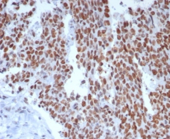 Immunohistochemistry analysis of MSH6 antibody in human small intestine tissue. MSH6 Antibody Recombinant Mouse MAb rMSH6/8181 was used for immunohistochemistry on FFPE human small intestine tissue. Strong HRP-DAB brown nuclear staining is observed in epithelial cells lining the intestinal glands and crypt regions, consistent with the nuclear localization of MutS homolog 6 (MSH6), a DNA mismatch repair protein involved in recognition of replication errors during DNA synthesis. The staining highlights proliferative epithelial cell populations within the mucosal compartment, while surrounding stromal and connective tissue elements show minimal signal. Heat-induced epitope retrieval was performed by boiling tissue sections in pH 9 10mM Tris with 1mM EDTA for 20 min followed by cooling prior to immunostaining.
