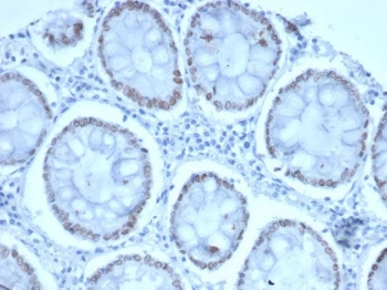 IHC staining of FFPE human colon tissue with SATB2 antibody (clone SATB2/7110). Strong nuclear staining is observed at 2ug/ml. HIER: boil tissue sections in pH 9 10mM Tris with 1mM EDTA for 20 min and allow to cool before testing.