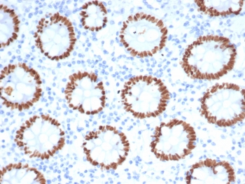 SATB2 Antibody Colon Tissue IHC. Immunohistochemistry staining of FFPE human colon tissue with SATB2 antibody. Strong nuclear staining is observed using clone SATB2/7112 at 2ug/ml. Inset: PBS used in place of primary Ab (secondary Ab negative control). HIER: boil tissue sections in pH 9 10mM Tris with 1mM EDTA for 20 min and allow to cool before testing.