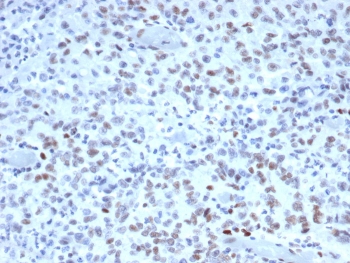 MutS homolog 2 Antibody (clone MSH2/3165) / MSH2 Antibody. Immunohistochemistry analysis of FFPE human colon tissue from a Lynch syndrome patient using MutS homolog 2 antibody (clone MSH2/3165). Nuclear brown chromogenic staining identifies MutS homolog 2 / MSH2-positive cells within the tissue, while surrounding stromal and inflammatory cells serve as internal reference staining. Heat-induced epitope retrieval was performed by boiling tissue sections in pH 9 10mM Tris with 1mM EDTA for 20 minutes followed by cooling prior to staining.